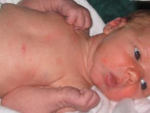 Image of baby with toxic erythema of the newborn