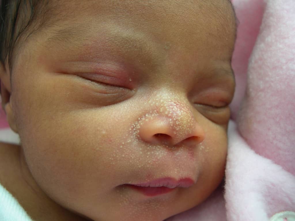 Milia is a common skin condition in newborns that goes on its own
