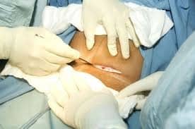 cutting the stomach of a woman for cesarean operation