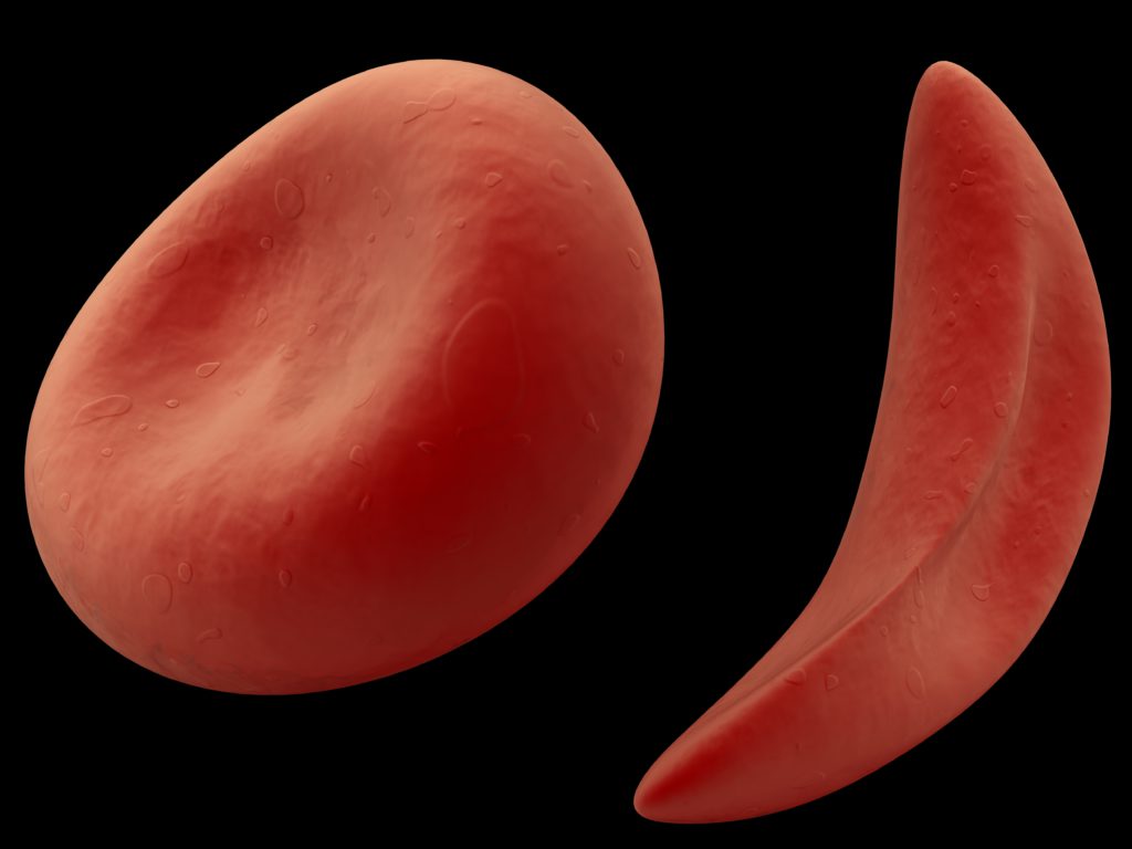 abnormal red blood cells can be C-shaped or sickle-shaped