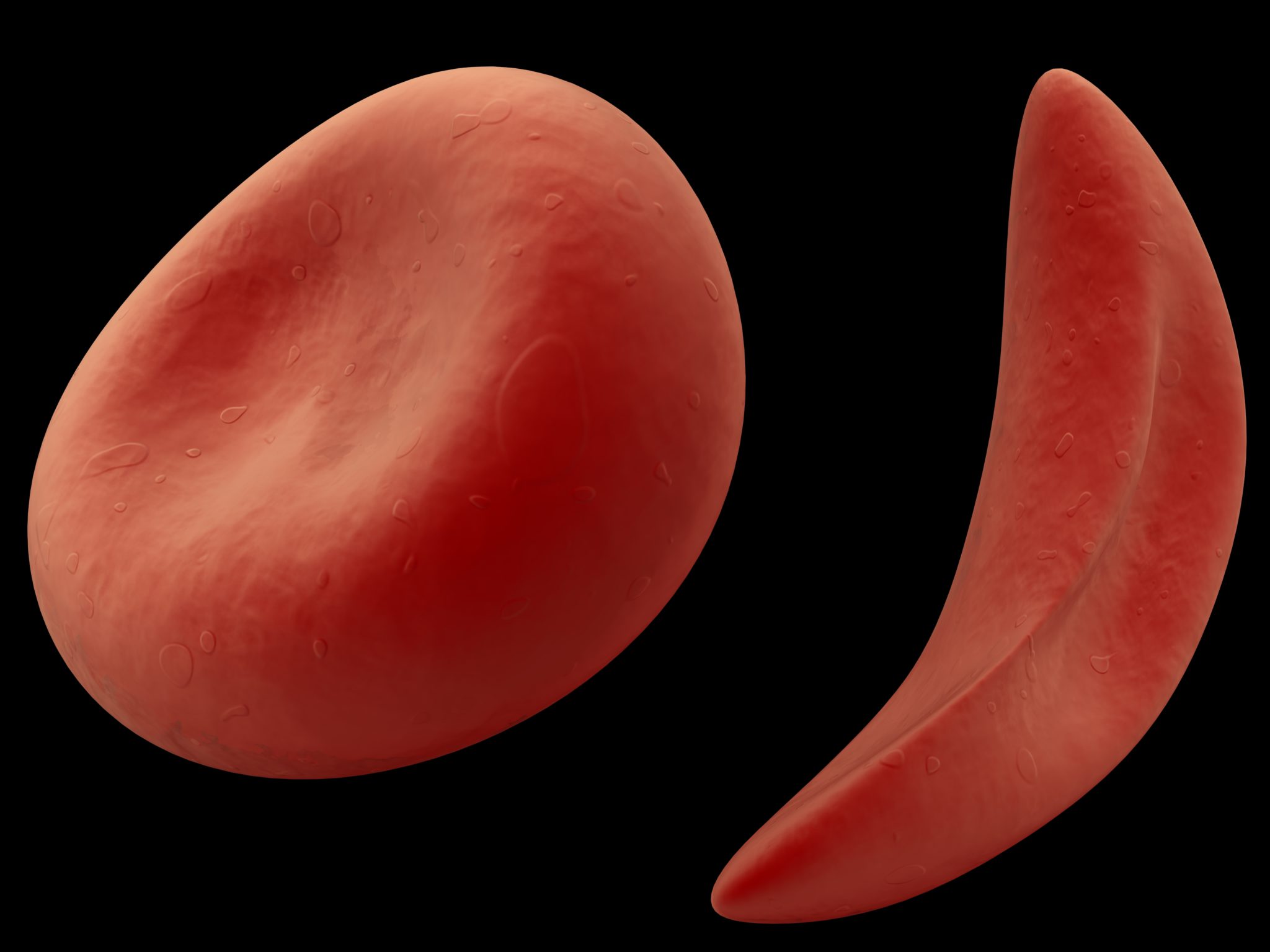 Серповидноклеточная анемия какая. Клеточная анемия серповидноклеточная. Эритроциты при серповидноклеточной анемии. Сероповидно клеточная анемия. 1) Серповидно-клеточная анемия.