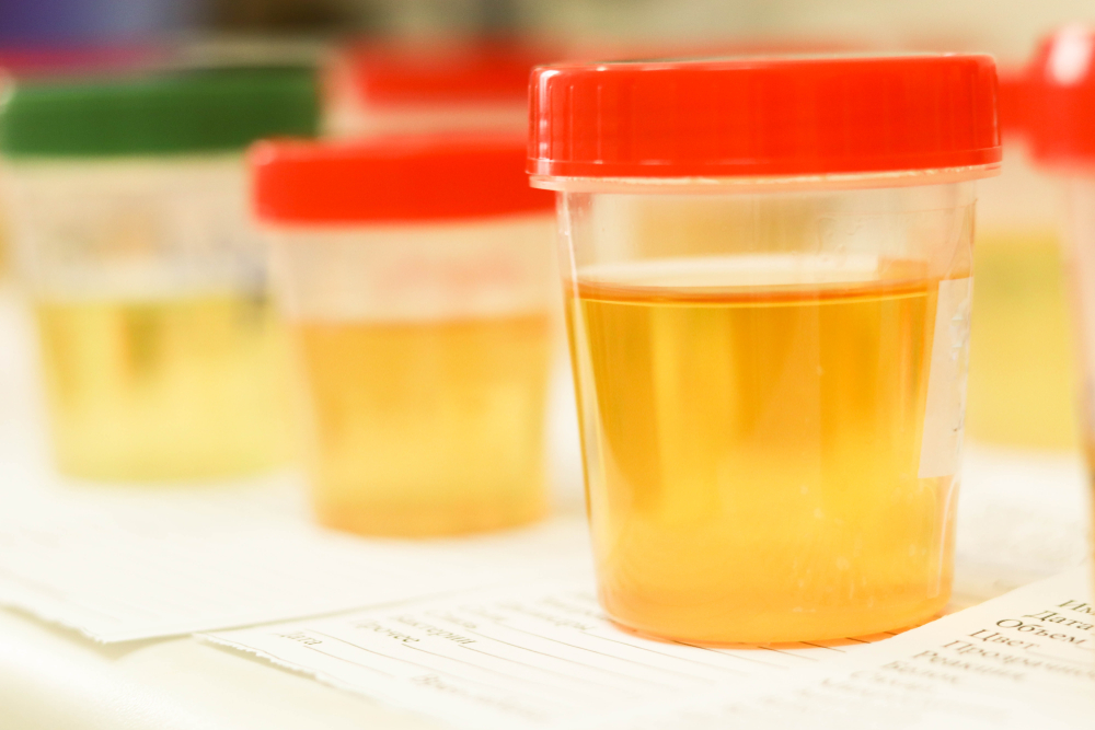 ketone in urine during pregnancy
