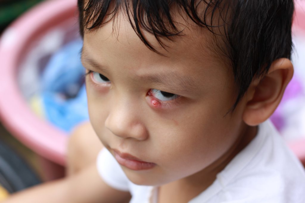 symptoms of stye baby eye