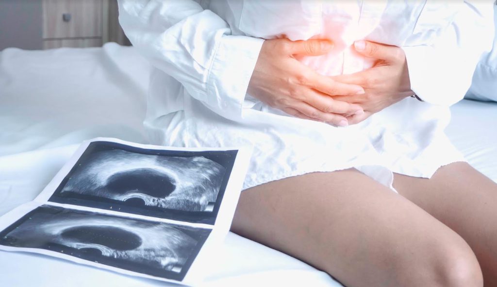Can Ovarian Cyst Cause Infertility